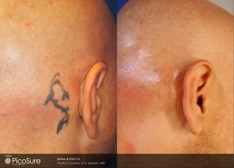 tattoo removal results behind man's ear