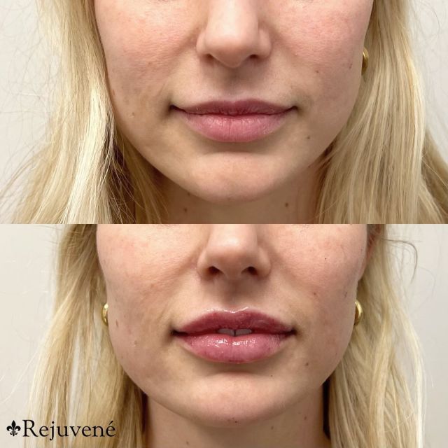 Cheek & Lip Enhancement 🤩
•
It’s no secret that your face changes over the years. Skin loses elasticity as you get older, and volume begins to disappear. 

The good news is that you do not have to settle for a loss of firmness & volume! 
•
Cheek filler restores volume to your cheeks and gives you a younger, fresher appearance. 

Lip filler plumps your lips, adding a more youthful fullness and giving a boost of hydration! 
•
💉 by Chelsea 
📞Call: 530.342.8295
📲DM: if you have any questions!

#fillerfriday #cheekandlips #filler #beforeandafter #fullerlips #hydrated