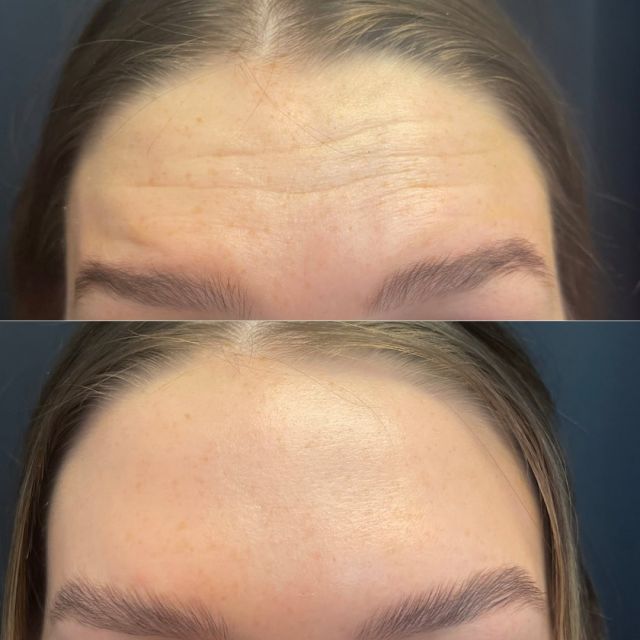 Wrinkles? Gone! 😍🙌🏼 

Look at these amazing results! A very common complaint from patients is that their forehead wrinkles bother them. Botox, as you can see, can smooth & brighten up the forehead. 🌟

👉🏼 It takes approximately 7-14 days to notice and see results! 
👉🏼 It is recommended every 3-4 months to achieve optimal results. 
👉🏼If you are interested in achieving this look, #taplinkinbio to book a consultation! 

💜 Bank your Botox all month of July! $11/UNIT 
#bankyourbotox #beforeafterpictures #byebyewrinkles #loveyourskin #betteryourlife
