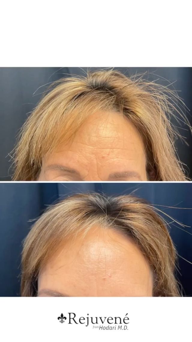 BYEEE 👋🏼 forehead wrinkles! 

Take a look at our beautiful patient's forehead before and after when she is RESTING 😌

One of the MANY benefits of Botox is the smoothness and glow that can be seen at rest! 

We love a good Botox glow ✨✨✨

📍: Chico, Yuba City & Oroville 
📞Call: 530.342.8295
📲DM: if you have any questions!

#hodarimddermatology #rejuvene #botoxbeforeandafter