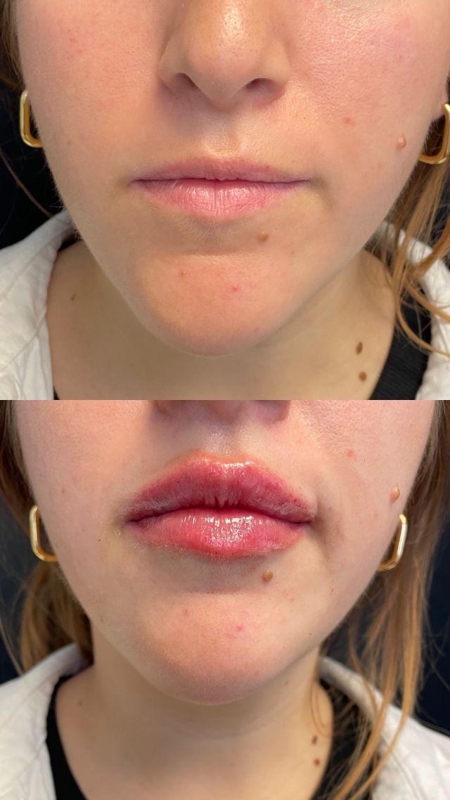 Juvéderm Volbella never disappoints 👄💉🫶🏻 

Shown here are first-time filler patients' lips before and after. The goal was to add volume and hydration, but of course keeping it natural! She looks fabulous! Obsessed🥰

Tap the link in our bio to book! ✨

#lipfiller #beforeandafter #lipinjections #natural #loveyourskin #betteryourlife