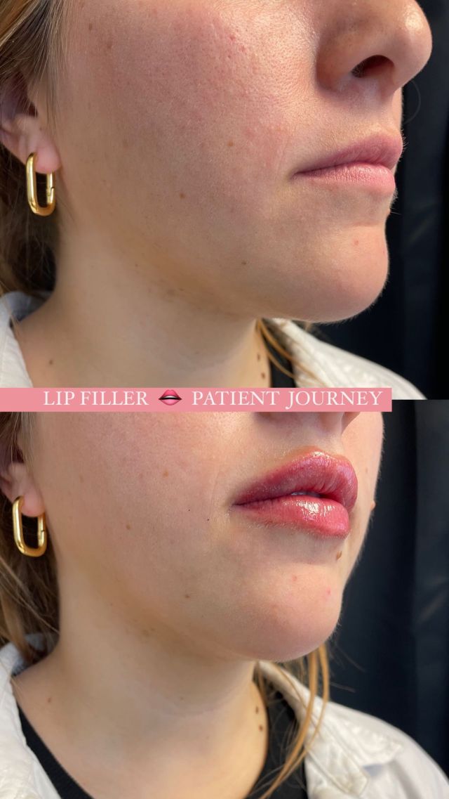 Lip Filler — Patient Journey 👄

It takes around two weeks for your lips to fully heal and settle, then you will be able to see the final results. 🥰 

Immediately after getting lip filler, it is normal to have some swelling, bruising, and tenderness. 

Have patience and trust the process! Restoring a youthful lip shape can take little time and effort but is WELL worth it! 🩷

If you’re interested in learning if lip filler is right for you, we would love to be a part of your aesthetic journey. Schedule your appointment today! ✨ 

#lipfiller #lips #loveyourskin #betteryourlife