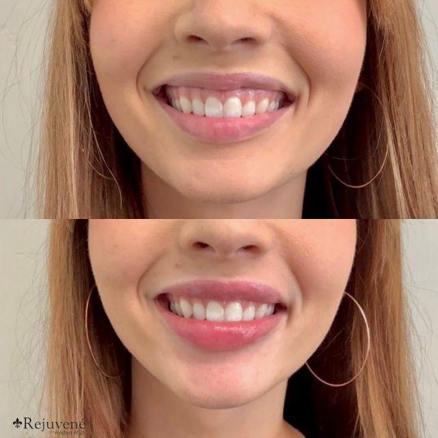 ✨ Lips by Dr. Hodari ✨

Interested in lip filler? Call today to book a cosmetic consultation 👄🍒💉 

#lipfiller #lips #natural #injectables #buttecounty