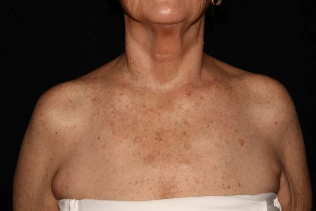 Say goodbye to sun damage and hello to radiant skin! This before & after shows the incredible results of a BBL photofacial on the chest—fading sun spots, evening skin tone, and restoring that youthful glow. 
Call us to schedule a consultation today!