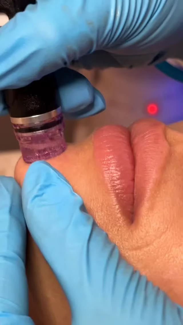 HydraFacial isn’t just a facial, it’s a skin reset. Deep cleanse, exfoliation, extraction, and hydration all in one luxurious treatment 💧💆‍♀️ Your glow starts here! 

#hydrafacial #hydrafacials #skincare #medspa #loveyourskin